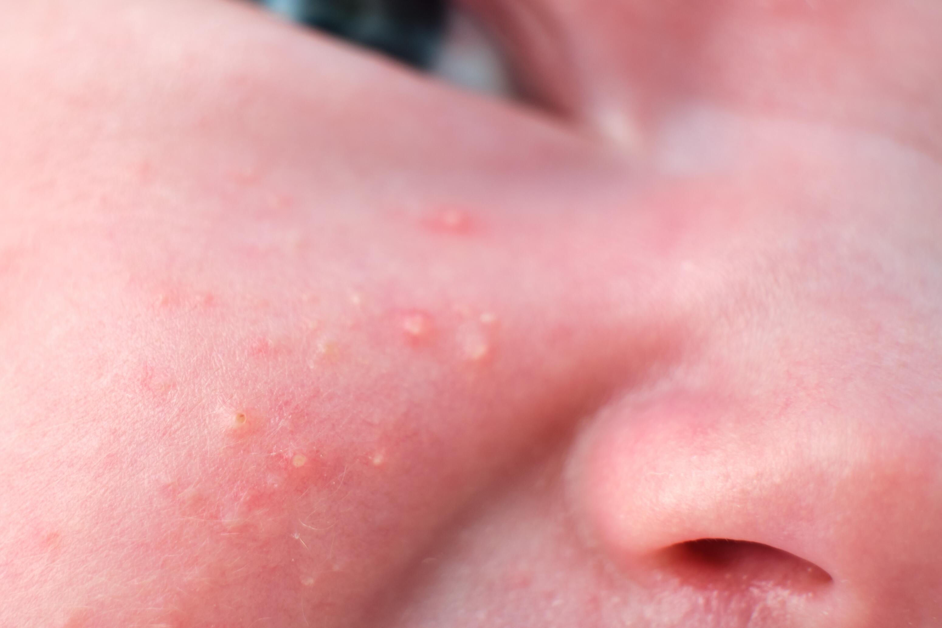 Symptomen van acne bij baby's (pasgeborenen)